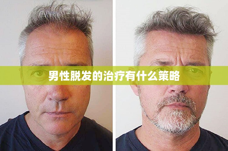 男性脱发的治疗有什么策略