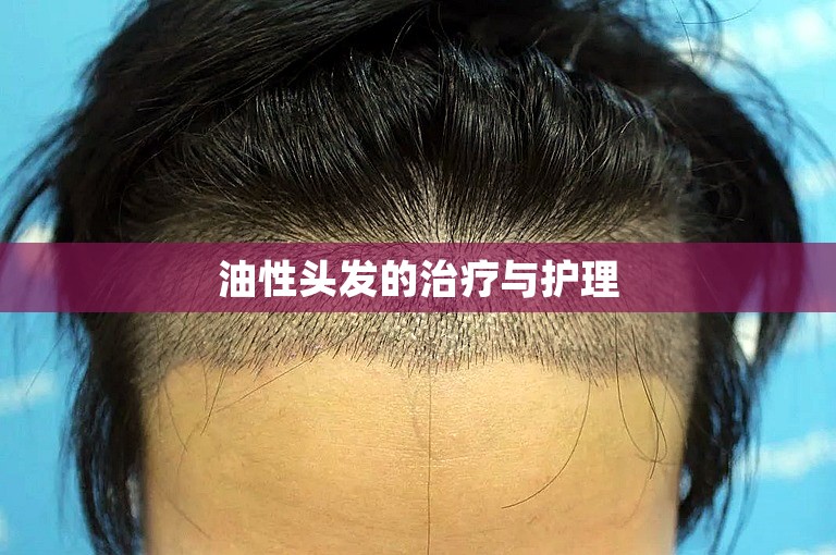油性头发的治疗与护理