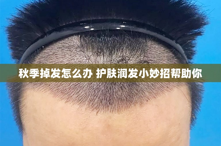 秋季掉发怎么办 护肤润发小妙招帮助你