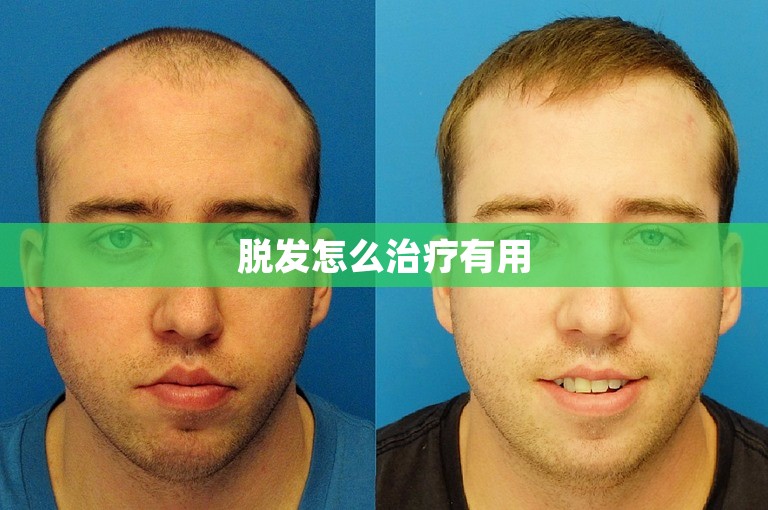 脱发怎么治疗有用 脱发怎么治疗有用