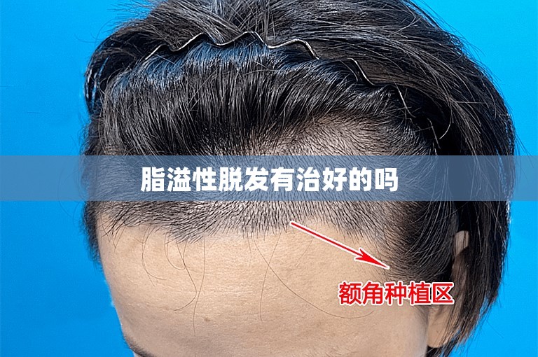 脂溢性脱发有治好的吗