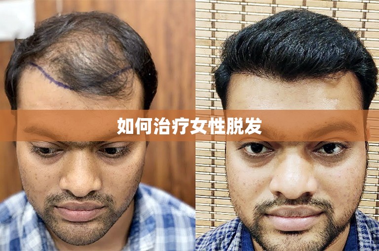 如何治疗女性脱发