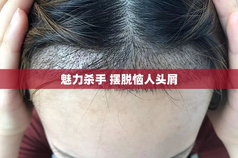 魅力杀手 摆脱恼人头屑