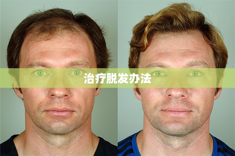 治疗脱发办法 治疗脱发办法