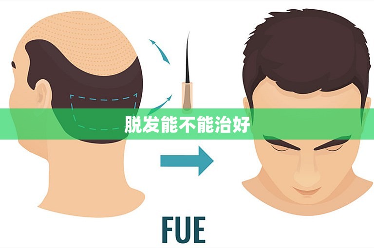脱发能不能治好
