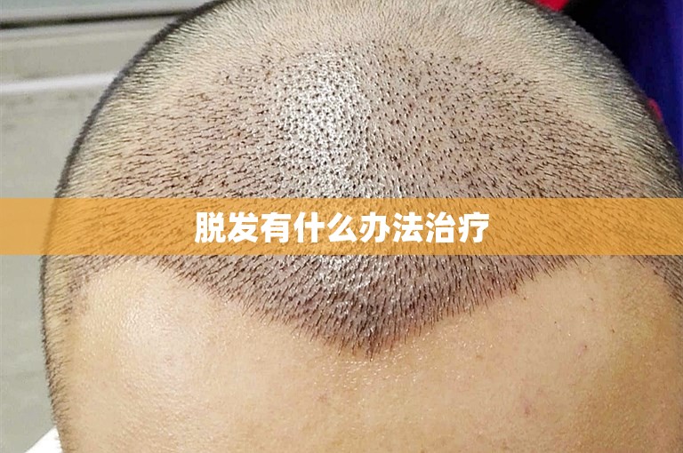 脱发有什么办法治疗