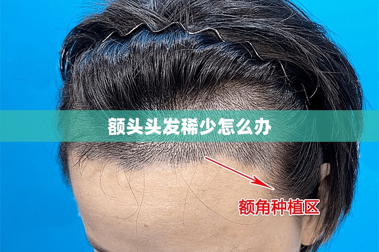 额头头发稀少怎么办 额头头发稀少怎么办