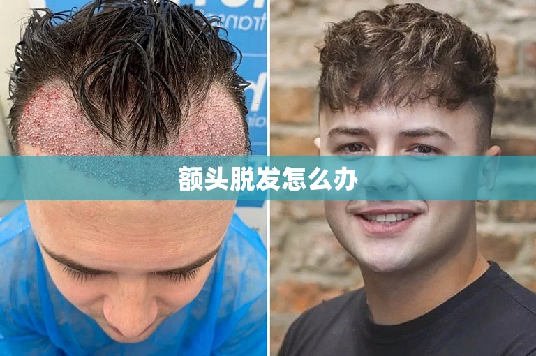 额头脱发怎么办 额头脱发怎么办
