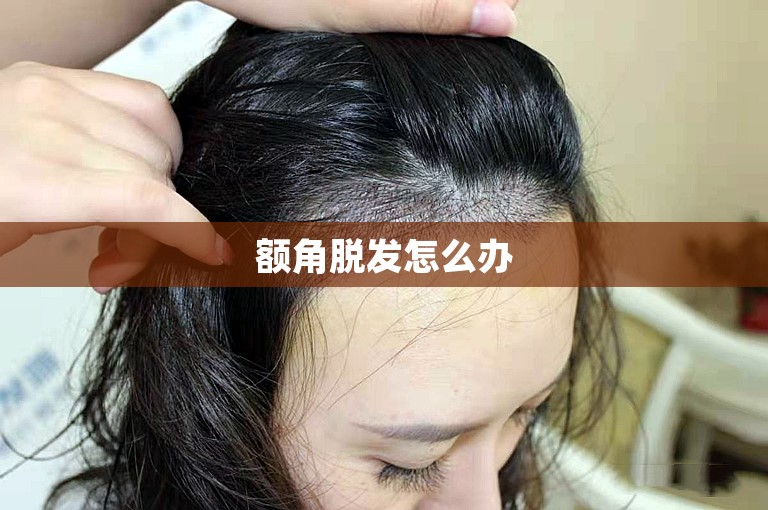 额角脱发怎么办 额角脱发怎么办