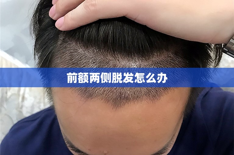 前额两侧脱发怎么办
