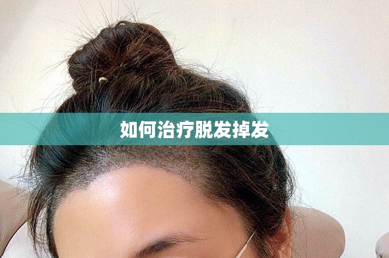 如何治疗脱发掉发