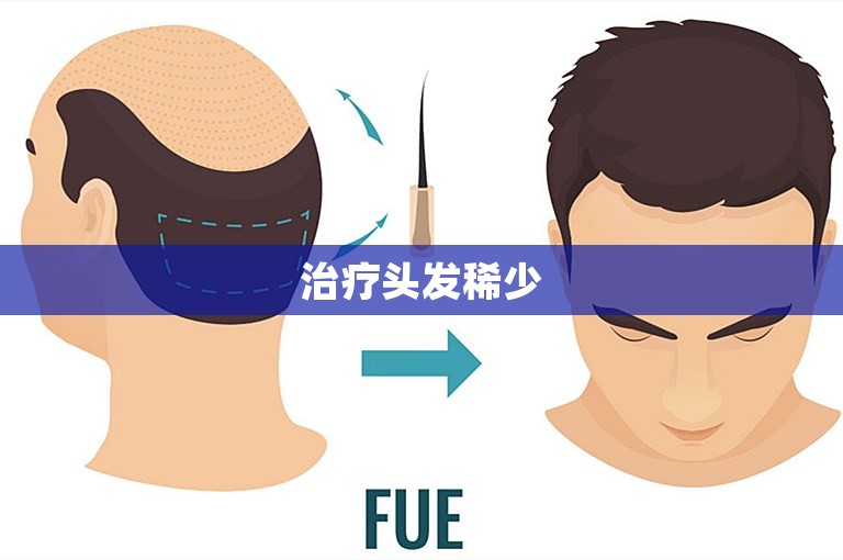 治疗头发稀少