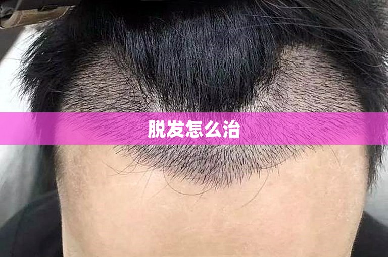 脱发怎么治