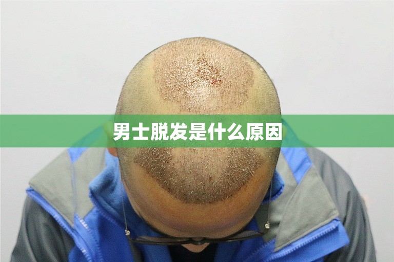 男士脱发是什么原因