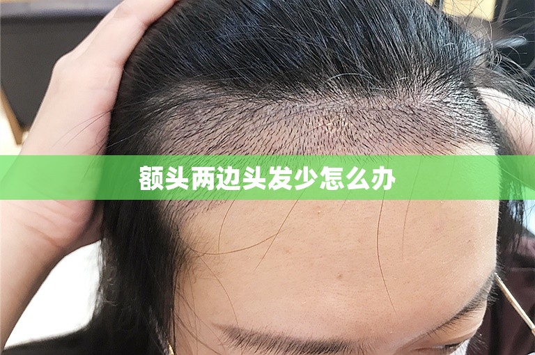 额头两边头发少怎么办 额头两边头发少怎么办