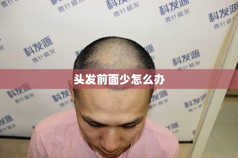 头发前面少怎么办