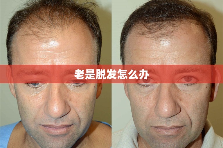 老是脱发怎么办