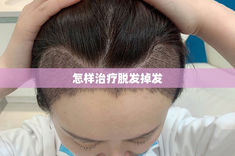 怎样治疗脱发掉发
