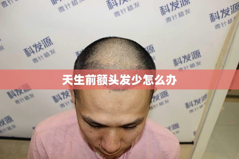 天生前额头发少怎么办