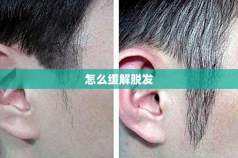 怎么缓解脱发
