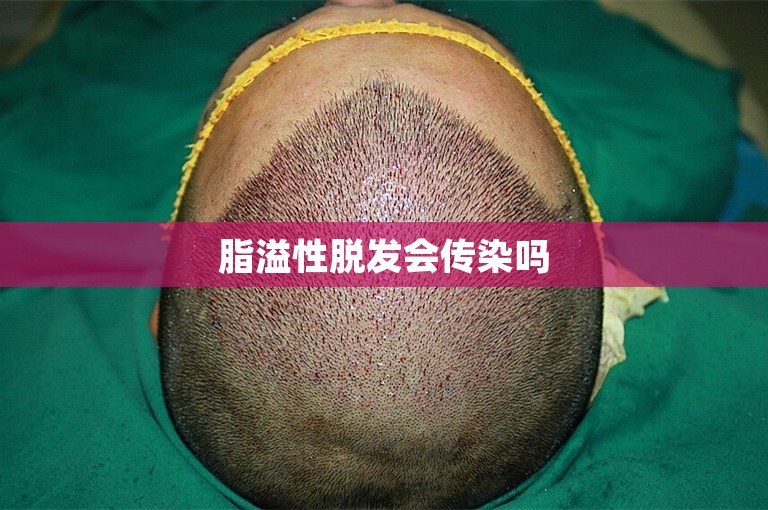脂溢性脱发会传染吗