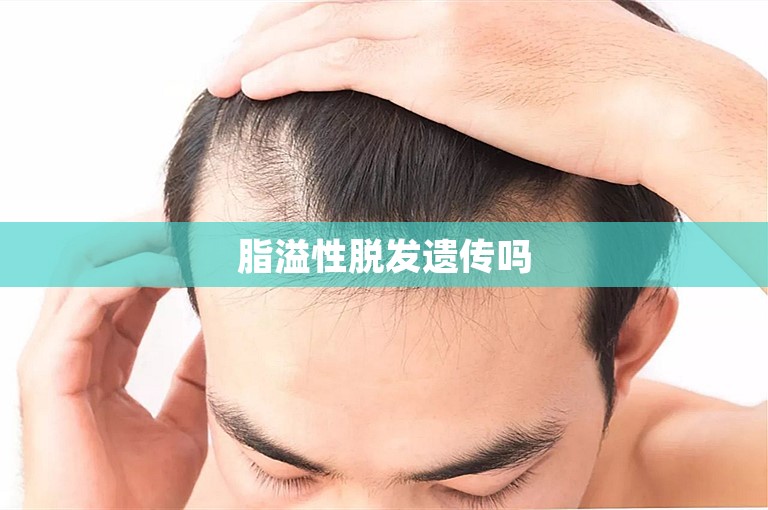 脂溢性脱发遗传吗