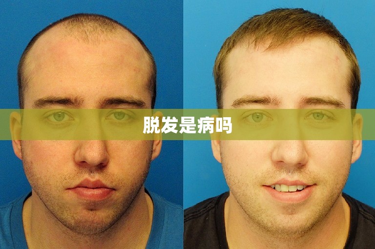 脱发是病吗 脱发是病吗