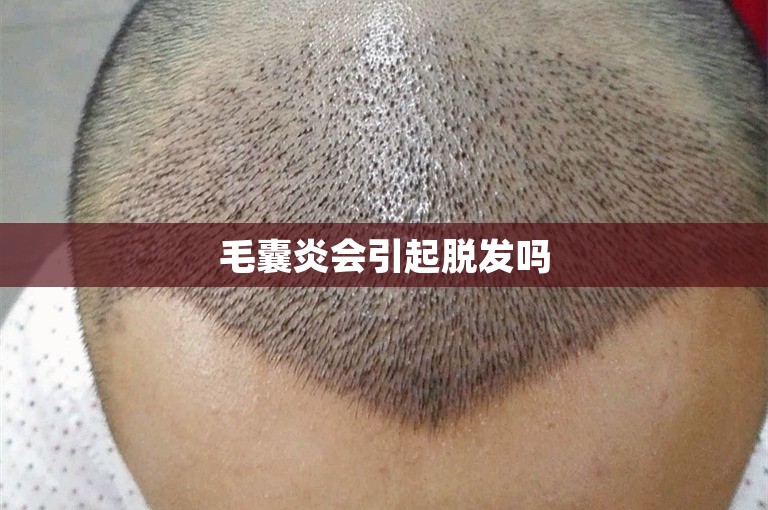 毛囊炎会引起脱发吗