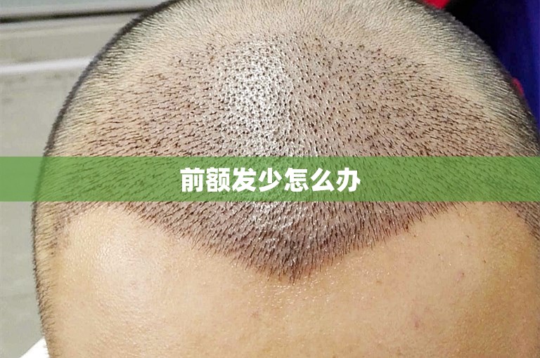 前额发少怎么办