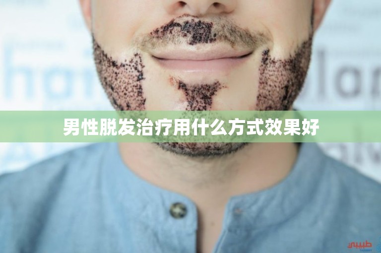 男性脱发治疗用什么方式效果好