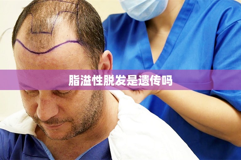 脂溢性脱发是遗传吗
