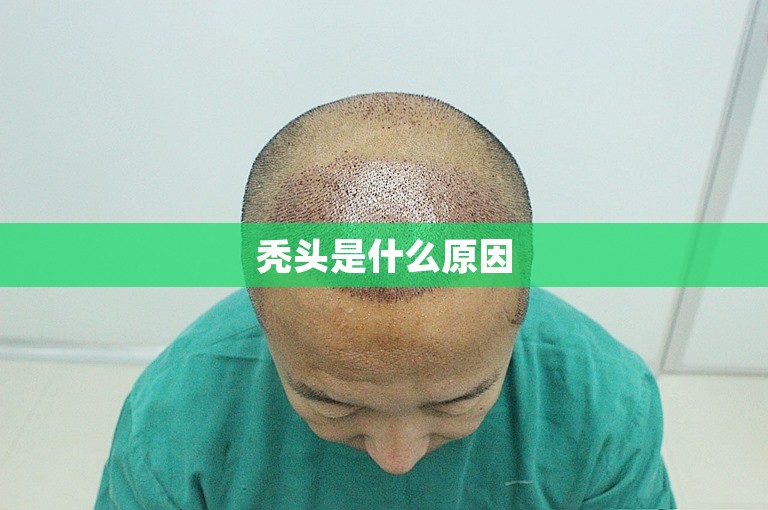 秃头是什么原因 秃头是什么原因