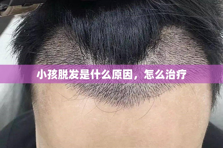 小孩脱发是什么原因，怎么治疗