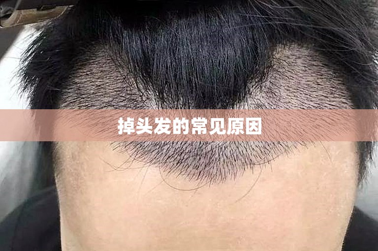 掉头发的常见原因