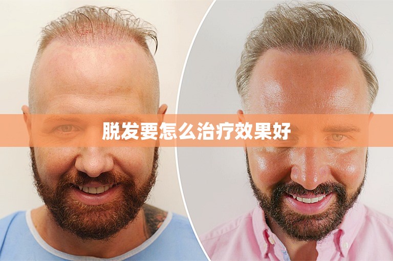 脱发要怎么治疗效果好