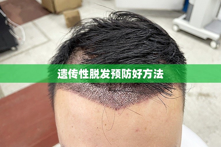 遗传性脱发预防好方法