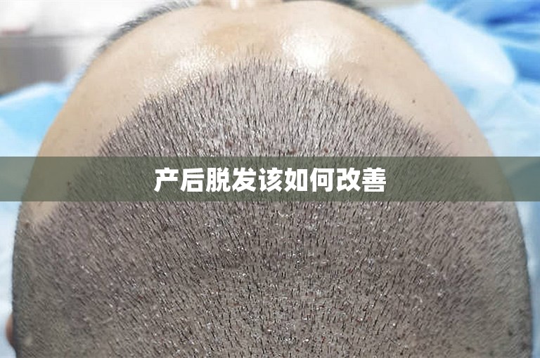 产后脱发该如何改善