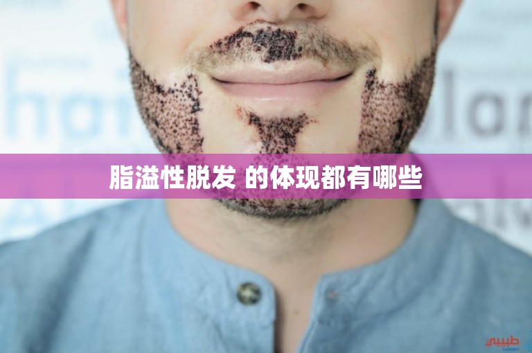 脂溢性脱发 的体现都有哪些 脂溢性脱发 的体现都有哪些