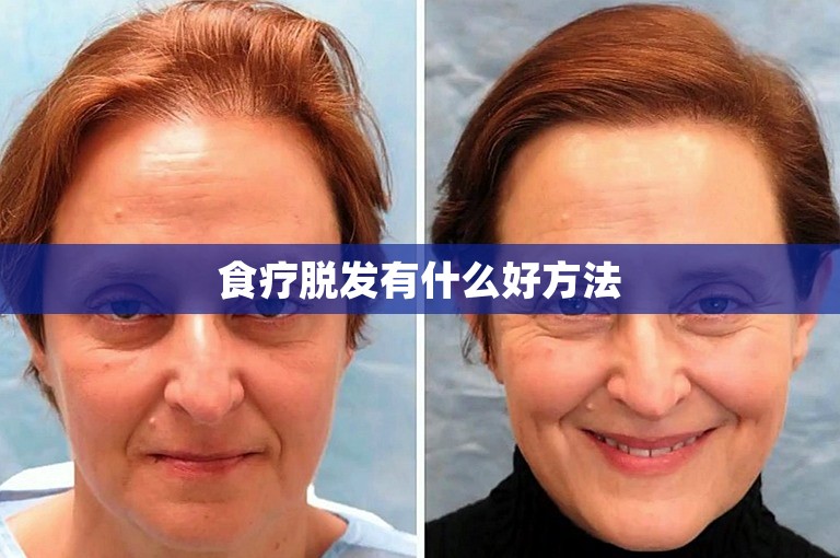 食疗脱发有什么好方法 食疗脱发有什么好方法