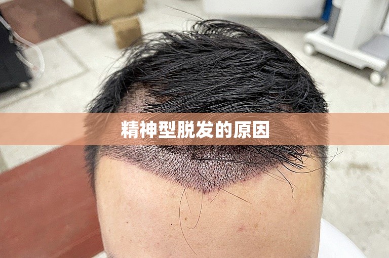 精神型脱发的原因