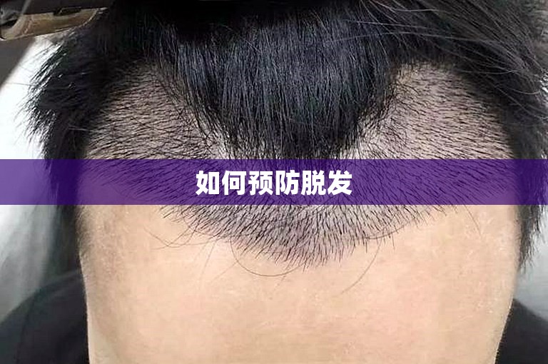 如何预防脱发 如何预防脱发