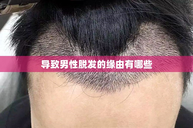 导致男性脱发的缘由有哪些