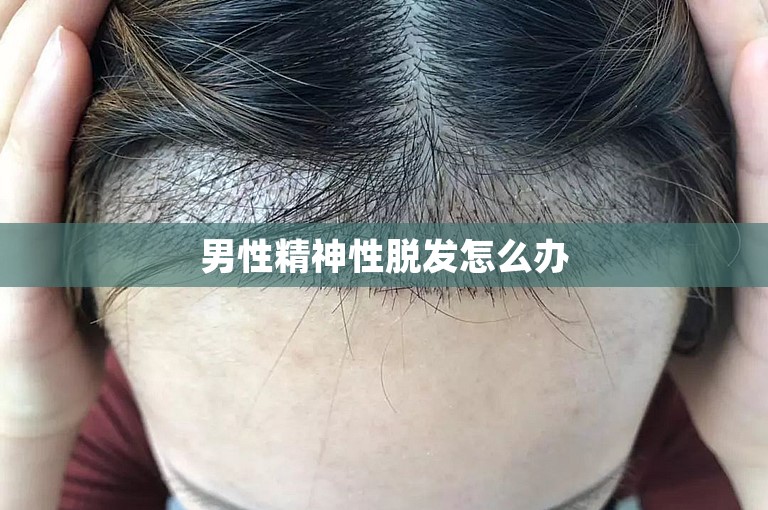 男性精神性脱发怎么办