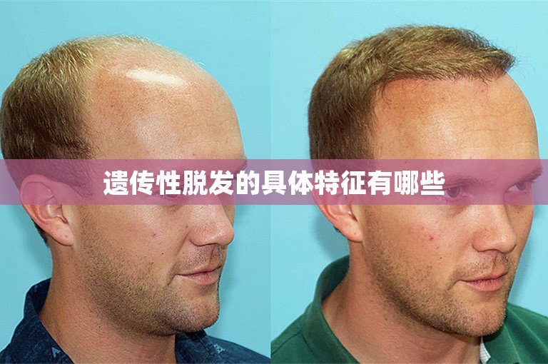 遗传性脱发的具体特征有哪些
