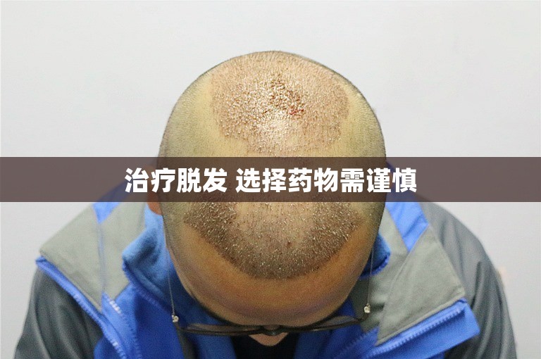 治疗脱发 选择药物需谨慎