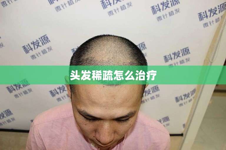 头发稀疏怎么治疗