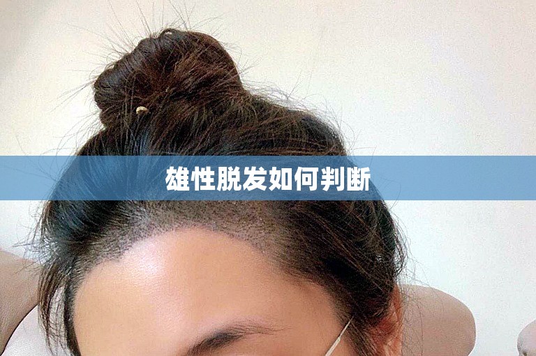 雄性脱发如何判断