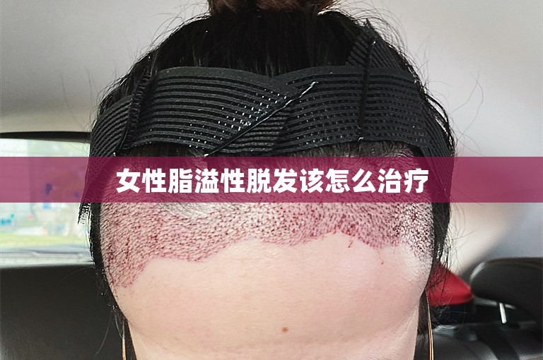 女性脂溢性脱发该怎么治疗