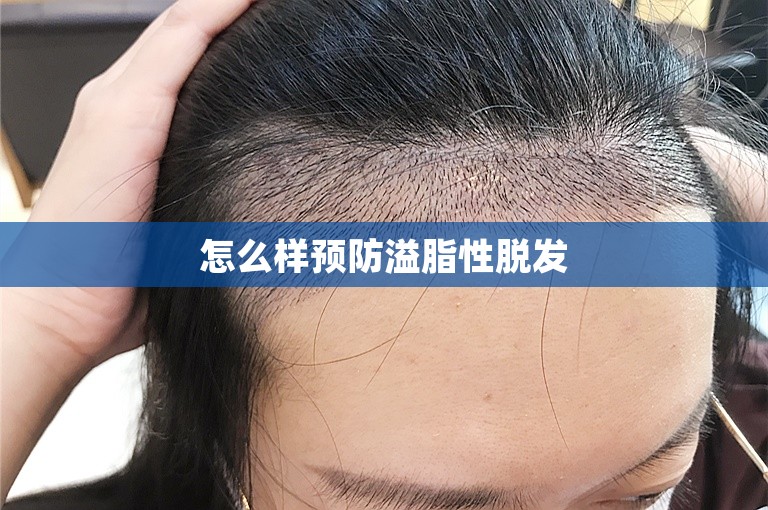 怎么样预防溢脂性脱发