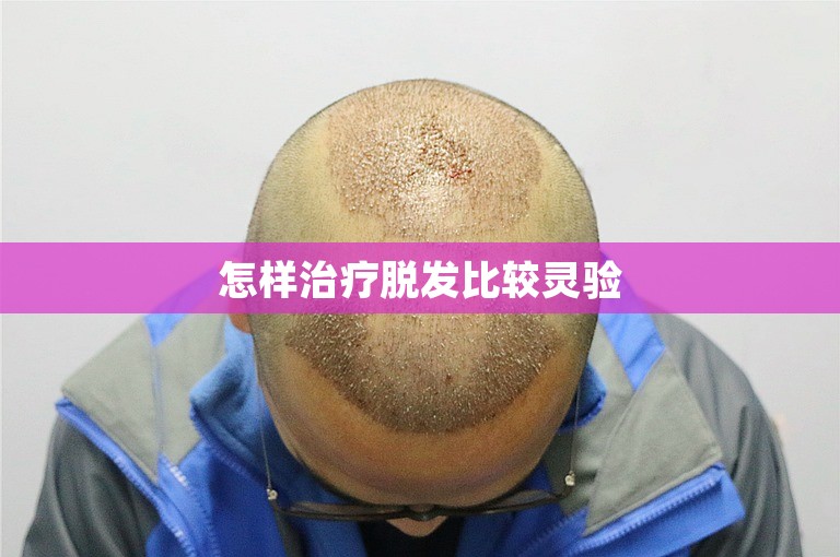 怎样治疗脱发比较灵验